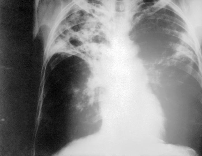 Radiografía de tórax con hallazgos de tuberculosis pulmonar. Foto: CDC, Wikimedia Commons (dominio público).